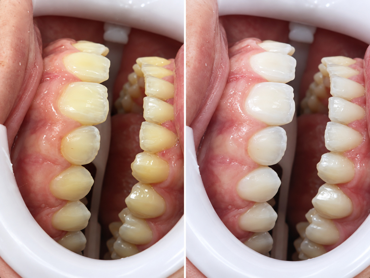 Antes e depois de clareamento: à esquerda os dentes antes, à direita depois
