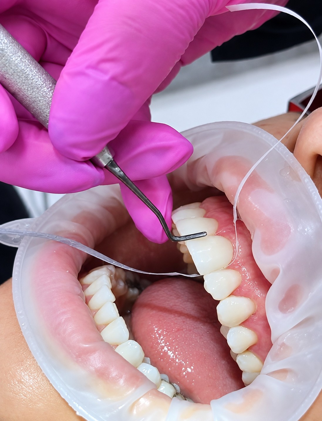 Dra. Alessandra ajustando lentes dentárias em uma paciente